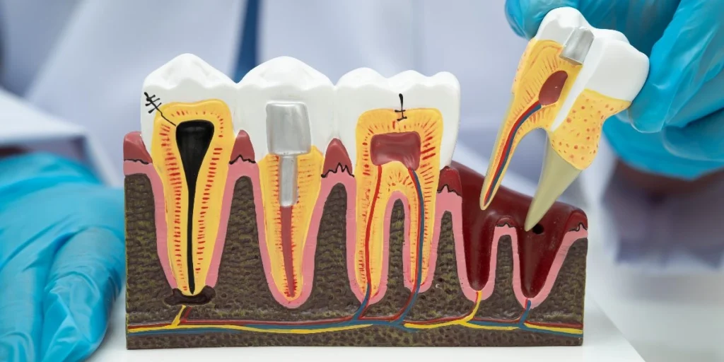 Endodontic
