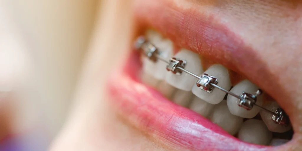 braces